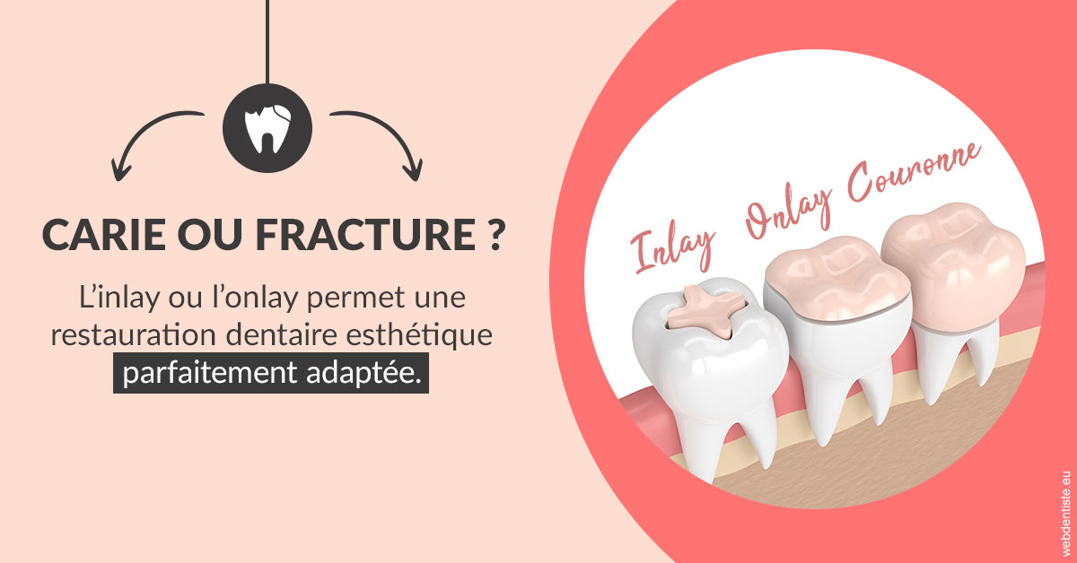 https://dr-atinault-philippe.chirurgiens-dentistes.fr/T2 2023 - Carie ou fracture 2