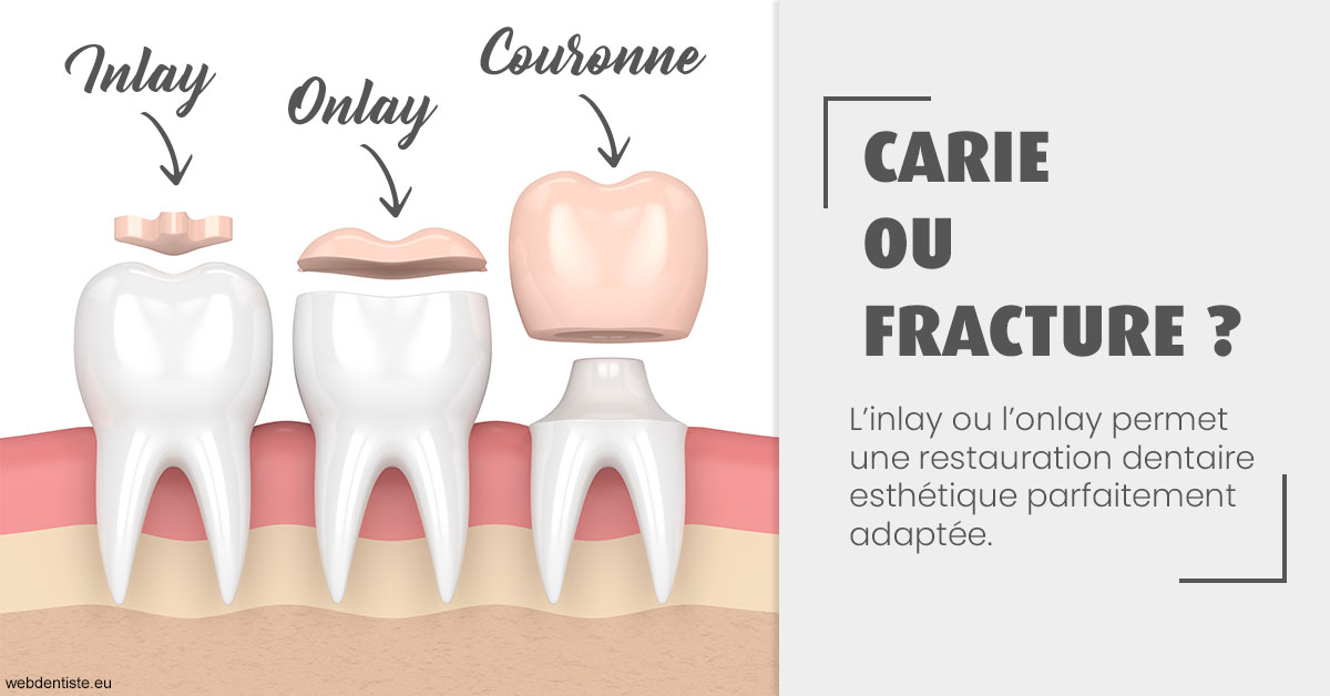 https://dr-atinault-philippe.chirurgiens-dentistes.fr/T2 2023 - Carie ou fracture 1