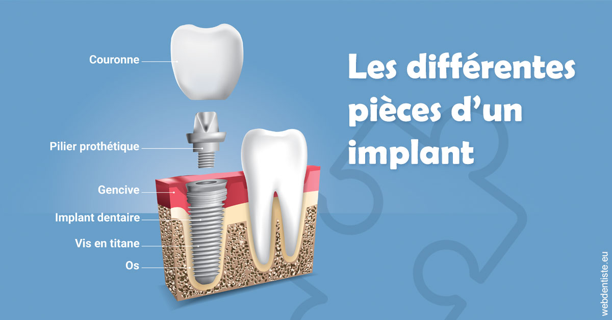 https://dr-atinault-philippe.chirurgiens-dentistes.fr/Les différentes pièces d’un implant 1
